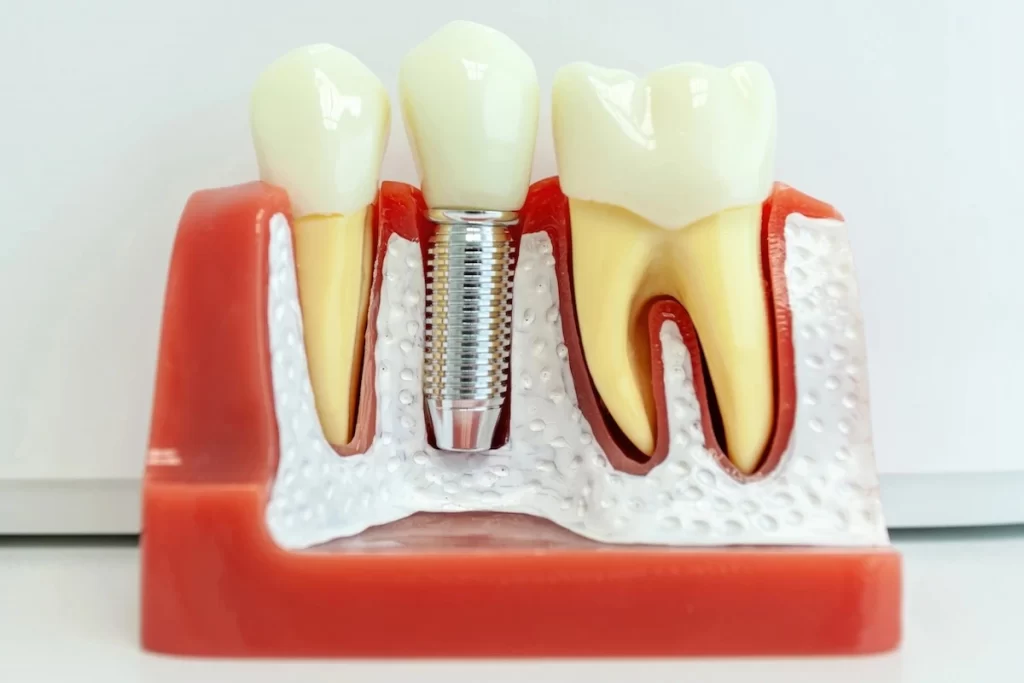 impiantodenti