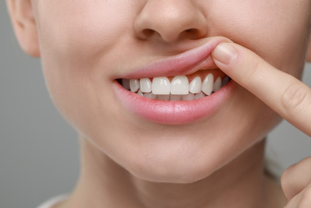 come-aggiustare-un-dente-scheggiato